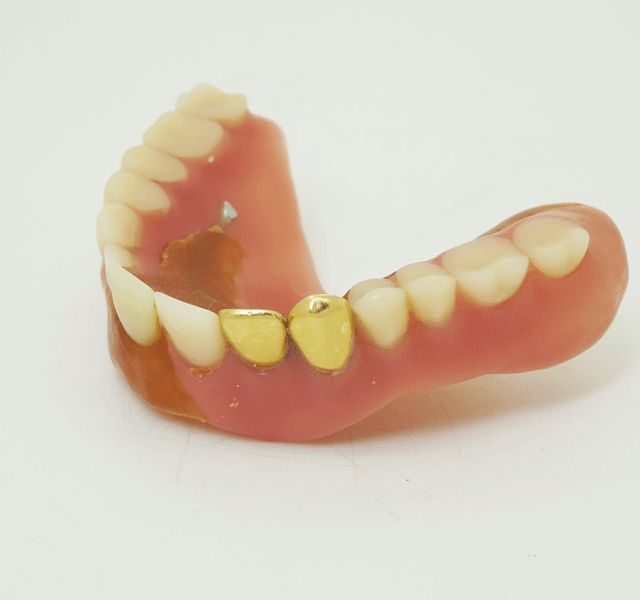 金歯　銀歯　入れ歯